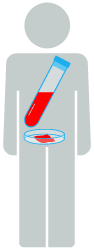 Tumor biopsy, blood cells
